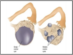a322b 1 سندرم تخمدان پلی کیستیک  باعث موارد ذیل میگردد (PCOS) * ناباروریزنان مبتلا به PCOS ممکن است به دلیل کمبود تخمک گذاری، در باردار شدن با مشکلمواجه شوند. بد نیست بدانید که این بیماری شایع ترین دلیلناباروری ناباروریدر زنان است.*چاقیدر حدود نیمی از زنان مبتلا به PCOS چاق هستند. در مقایسه با زنان همسن که سندرم تخمدان پلی کیستیک ندارند، زنان مبتلا، احتمال بیشتری دارد که دچاراضافه وزن یاچاقی چاقیباشند. * پیش دیابت یا دیابت نوع 2بسیاری از زنان مبتلا به PCOS، دچار مقاومت بهانسولین انسولینهستند که این امر توانایی بدن برایاستفاده ی بهینه از انسولین جهت تنظیم قند خون را مختل می کند. این موضوع می تواندسبب بالا رفتن قند خون و در نتیجه دیابت نوع 2 گردد. نام دیگرپیش دیابتپیش دیابت، اختلال در تحمل گلوکز است. * آکانتوز سیاه (Acanthosis nigricans)یک اصطلاح پزشکی است که به وجود پوست مخملی و تیره بر روی پشت گردن،زیر بغل، اعضای تناسلی خارجی و زیر پستان ها اطلاق می شود. وجود این شرایط در پوستیکی از نشانه های مقاومت به انسولین است. با کمک سونوگرافی می توان تخمدان های بزرگ حاوی تعداد زیادی کیستکوچک را مشخص کرد. اما برخلاف آن چه از نام آن پیداست، تنها با وجود تخمدان های پلی