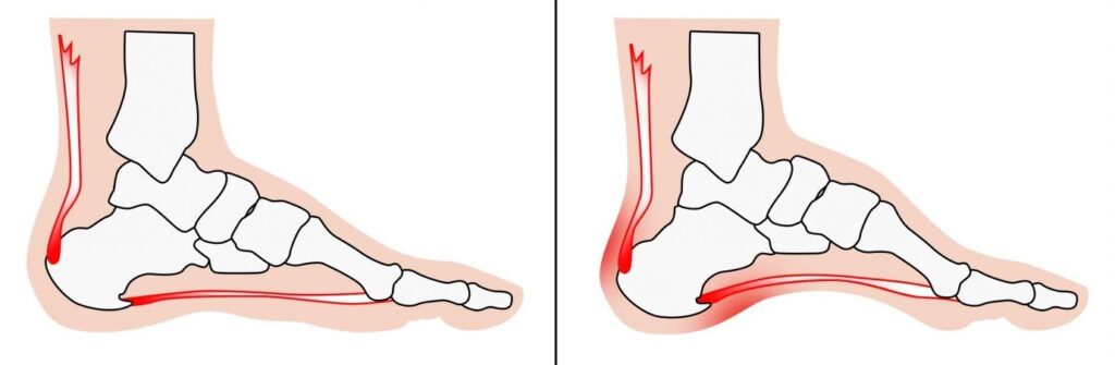 گودی زیاد کف پا (Pes Cavus) چیست؟ 2 image 13 گودی زیاد کف پا یا قوس بیش از حد کف پا، یکی از ناهنجاریهای اسکلتی در ساختار پا است که در آن، قوس طولی داخلی پا بیش از حد طبیعی بالا رفته و کف پا به زمین نمیچسبد. برخلاف صافی کف پا که در آن تماس کامل با زمین ایجاد میشود، در گودی زیاد، فشار وزن بدن عمدتاً بر پاشنه و پنجهی پا وارد میشود، و نواحی میانی پا تقریباً در تماس با زمین نیستند.