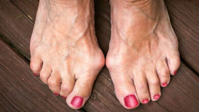 image 14 شست کجی یا به‌عبارتی تخصصی‌تر هالوکس والگوس (Hallux Valgus) یکی از شایع‌ ترین ناهنجاری‌های پا است که در آن، مفصل پایه‌ی انگشت شست پا به سمت بیرون (به طرف سایر انگشتان) منحرف می‌شود و در نتیجه، یک برآمدگی استخوانی در لبه داخلی پا ظاهر می‌شود. این برآمدگی گاهی با التهاب، درد، و محدودیت حرکت همراه است. شست کج بیشتر در زنان، به‌خصوص در سنین میانسالی به بالا دیده می‌شود، ولی می‌تواند در افراد جوان یا حتی کودکان نیز دیده شود.