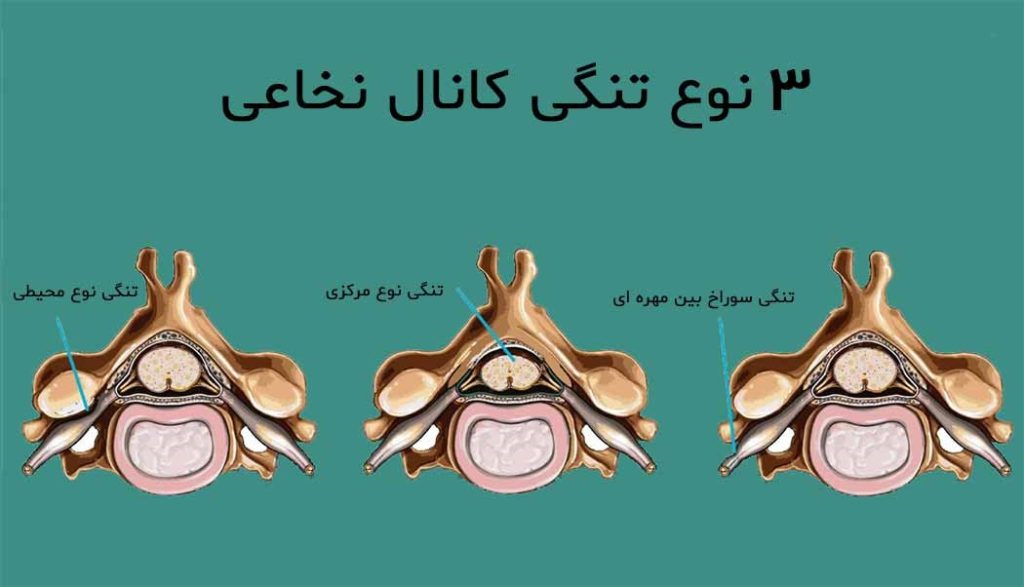 راهنمای انتخاب بهترین دکتر تنگی کانال نخاعی در شیراز 3 image 16 تنگی کانال نخاعی یکی از مشکلات شایع ستون فقرات است که میتواند زندگی روزمره افراد را مختل کند. درد، گزگز، بیحسی، ضعف عضلانی و محدود شدن حرکت تنها بخشی از علائمی هستند که بیماران مبتلا به این عارضه تجربه میکنند. انتخاب یک پزشک حاذق و متخصص در زمینه ارتوپدی و اختلالات نخاعی، مهمترین گام برای درمان اصولی این مشکل است. در این مقاله، ضمن بررسی نکات مهم برای انتخاب بهترین دکتر تنگی کانال نخاعی در شیراز، به معرفی دکتر زکیه مشکساری، متخصص ارتوپدی نیز خواهیم پرداخت.