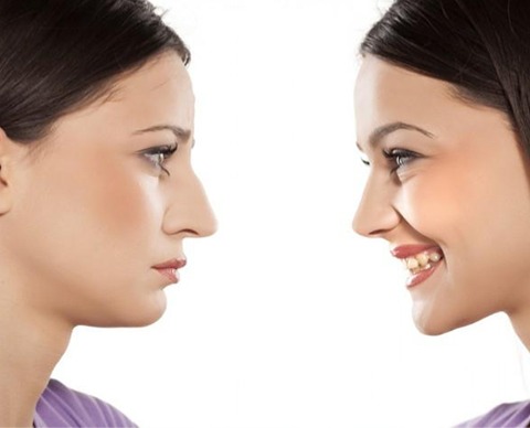 غضروف طبیعی یا مصنوعی؟ کدام پیوند تضمینکننده ماندگاری و نتیجه بهتر در جراحی بینی است؟ 1 غضروف طبیعی یا غضروف مصنوعی دکتر مفرد