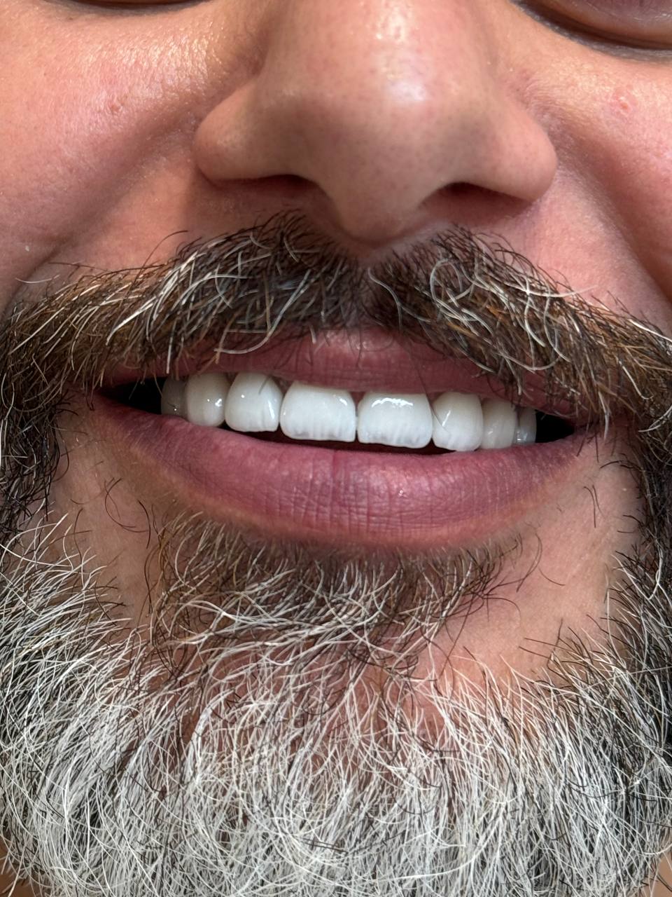 03738487 b33a 4ff2 8886 d6302b47fbc1 داشتن لبخندی جذاب و دندان‌هایی سالم، نه تنها زیبایی ظاهری را بهبود می‌بخشد، بلکه اعتماد به نفس و کیفیت زندگی فرد را نیز افزایش می‌دهد. امروزه لمینت دندان یکی از روش‌های محبوب برای اصلاح لبخند و تغییر رنگ و شکل دندان‌ها در شیراز به شمار می‌رود. اما نکته کلیدی این است که چگونه می‌توان بهترین دکتر لمینت دندان در شیراز را پیدا کرد و از نتایج درمان اطمینان حاصل کرد. در این صفحه، به بررسی تمام مراحل، نکات تخصصی و مزایای لمینت دندان پرداخته و راهنمای انتخاب بهترین پزشک را ارائه می‌دهیم.