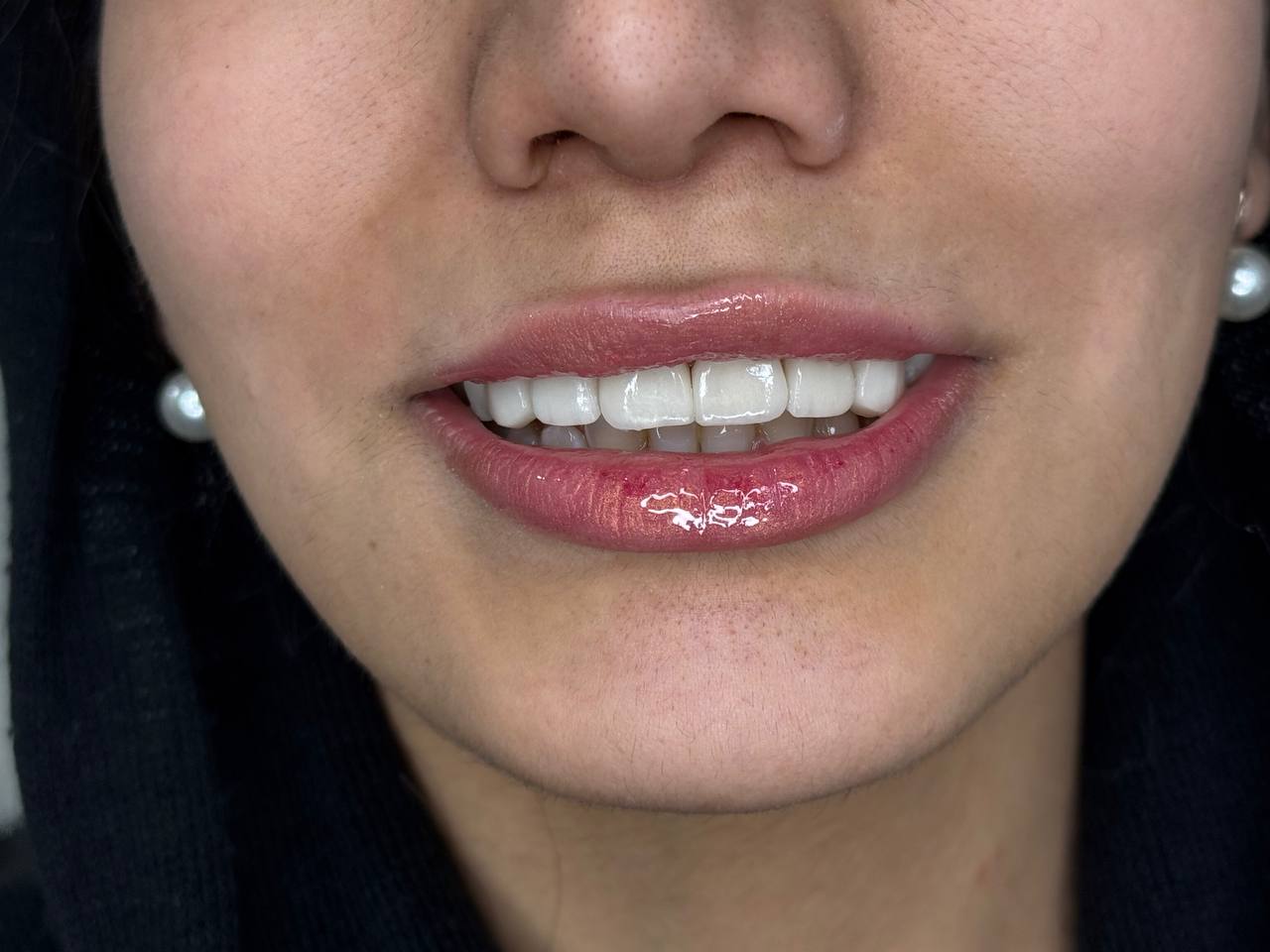 79047f36 ea73 4d25 af8c 38e5e93d759d داشتن لبخندی جذاب و دندان‌هایی سالم، نه تنها زیبایی ظاهری را بهبود می‌بخشد، بلکه اعتماد به نفس و کیفیت زندگی فرد را نیز افزایش می‌دهد. امروزه لمینت دندان یکی از روش‌های محبوب برای اصلاح لبخند و تغییر رنگ و شکل دندان‌ها در شیراز به شمار می‌رود. اما نکته کلیدی این است که چگونه می‌توان بهترین دکتر لمینت دندان در شیراز را پیدا کرد و از نتایج درمان اطمینان حاصل کرد. در این صفحه، به بررسی تمام مراحل، نکات تخصصی و مزایای لمینت دندان پرداخته و راهنمای انتخاب بهترین پزشک را ارائه می‌دهیم.