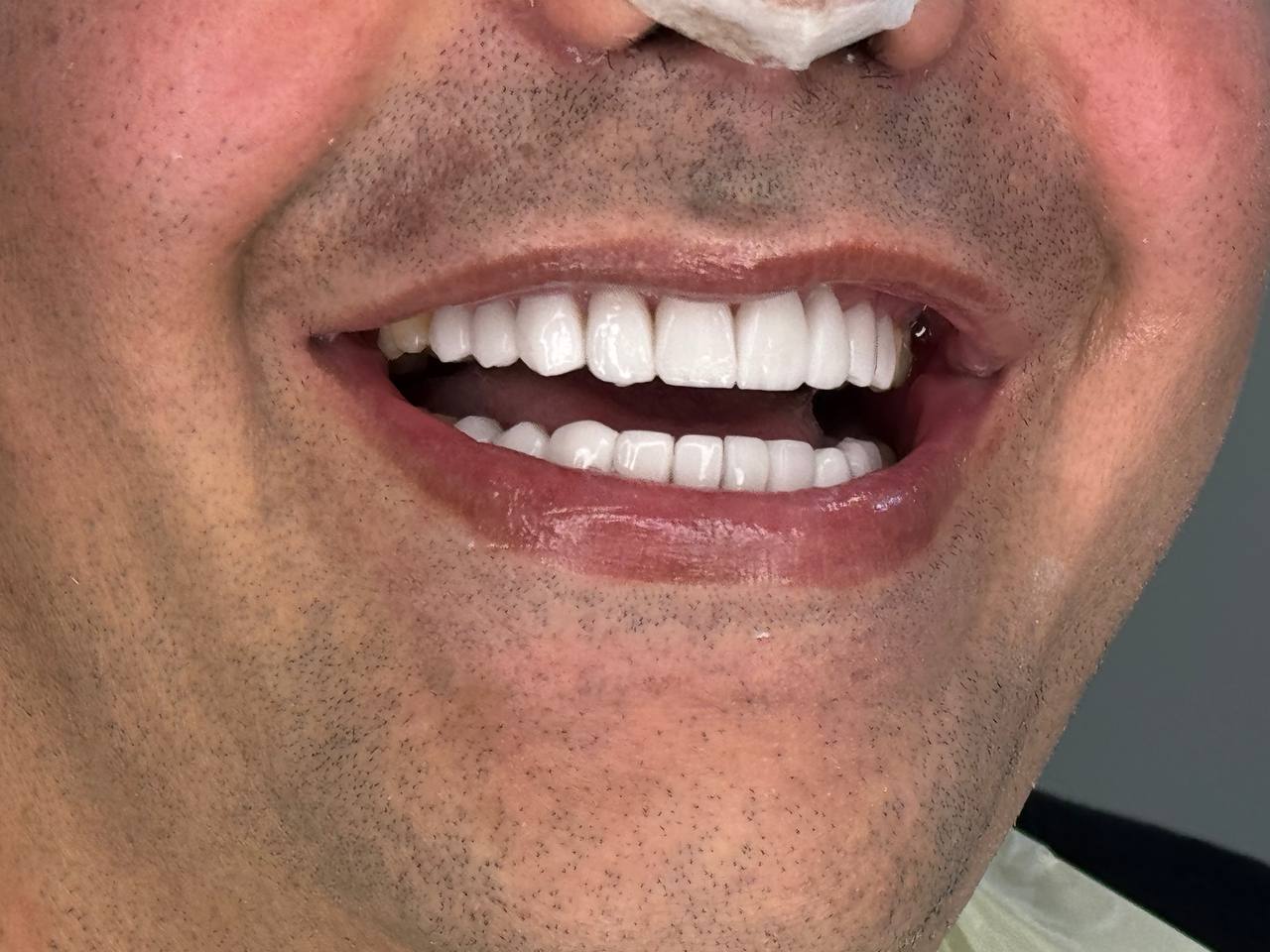 79acdd1c 4fe8 45df 94a3 0bfc33ed6be1 داشتن لبخندی جذاب و دندان‌هایی سالم، نه تنها زیبایی ظاهری را بهبود می‌بخشد، بلکه اعتماد به نفس و کیفیت زندگی فرد را نیز افزایش می‌دهد. امروزه لمینت دندان یکی از روش‌های محبوب برای اصلاح لبخند و تغییر رنگ و شکل دندان‌ها در شیراز به شمار می‌رود. اما نکته کلیدی این است که چگونه می‌توان بهترین دکتر لمینت دندان در شیراز را پیدا کرد و از نتایج درمان اطمینان حاصل کرد. در این صفحه، به بررسی تمام مراحل، نکات تخصصی و مزایای لمینت دندان پرداخته و راهنمای انتخاب بهترین پزشک را ارائه می‌دهیم.