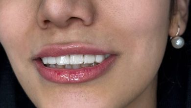 b84919dd 9c2f 4d0e af2c c334974b3a97 داشتن لبخندی جذاب و دندان‌هایی سالم، نه تنها زیبایی ظاهری را بهبود می‌بخشد، بلکه اعتماد به نفس و کیفیت زندگی فرد را نیز افزایش می‌دهد. امروزه لمینت دندان یکی از روش‌های محبوب برای اصلاح لبخند و تغییر رنگ و شکل دندان‌ها در شیراز به شمار می‌رود. اما نکته کلیدی این است که چگونه می‌توان بهترین دکتر لمینت دندان در شیراز را پیدا کرد و از نتایج درمان اطمینان حاصل کرد. در این صفحه، به بررسی تمام مراحل، نکات تخصصی و مزایای لمینت دندان پرداخته و راهنمای انتخاب بهترین پزشک را ارائه می‌دهیم.