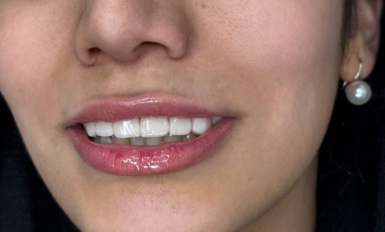 b84919dd 9c2f 4d0e af2c c334974b3a97 داشتن لبخندی جذاب و دندان‌هایی سالم، نه تنها زیبایی ظاهری را بهبود می‌بخشد، بلکه اعتماد به نفس و کیفیت زندگی فرد را نیز افزایش می‌دهد. امروزه لمینت دندان یکی از روش‌های محبوب برای اصلاح لبخند و تغییر رنگ و شکل دندان‌ها در شیراز به شمار می‌رود. اما نکته کلیدی این است که چگونه می‌توان بهترین دکتر لمینت دندان در شیراز را پیدا کرد و از نتایج درمان اطمینان حاصل کرد. در این صفحه، به بررسی تمام مراحل، نکات تخصصی و مزایای لمینت دندان پرداخته و راهنمای انتخاب بهترین پزشک را ارائه می‌دهیم.