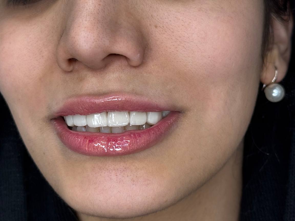 b84919dd 9c2f 4d0e af2c c334974b3a97 داشتن لبخندی جذاب و دندان‌هایی سالم، نه تنها زیبایی ظاهری را بهبود می‌بخشد، بلکه اعتماد به نفس و کیفیت زندگی فرد را نیز افزایش می‌دهد. امروزه لمینت دندان یکی از روش‌های محبوب برای اصلاح لبخند و تغییر رنگ و شکل دندان‌ها در شیراز به شمار می‌رود. اما نکته کلیدی این است که چگونه می‌توان بهترین دکتر لمینت دندان در شیراز را پیدا کرد و از نتایج درمان اطمینان حاصل کرد. در این صفحه، به بررسی تمام مراحل، نکات تخصصی و مزایای لمینت دندان پرداخته و راهنمای انتخاب بهترین پزشک را ارائه می‌دهیم.