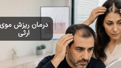 ریزش موی ارثی